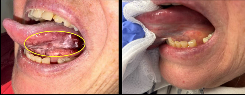 PRV111 before and after — lesion clearance example 1