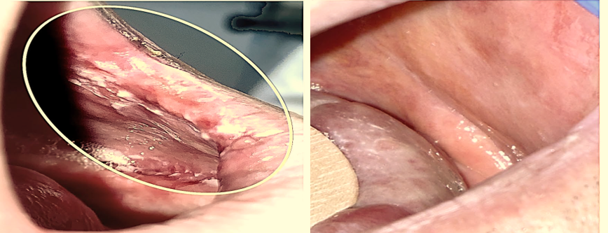 PRV111 before and after — high grade dysplasia clearance example 2